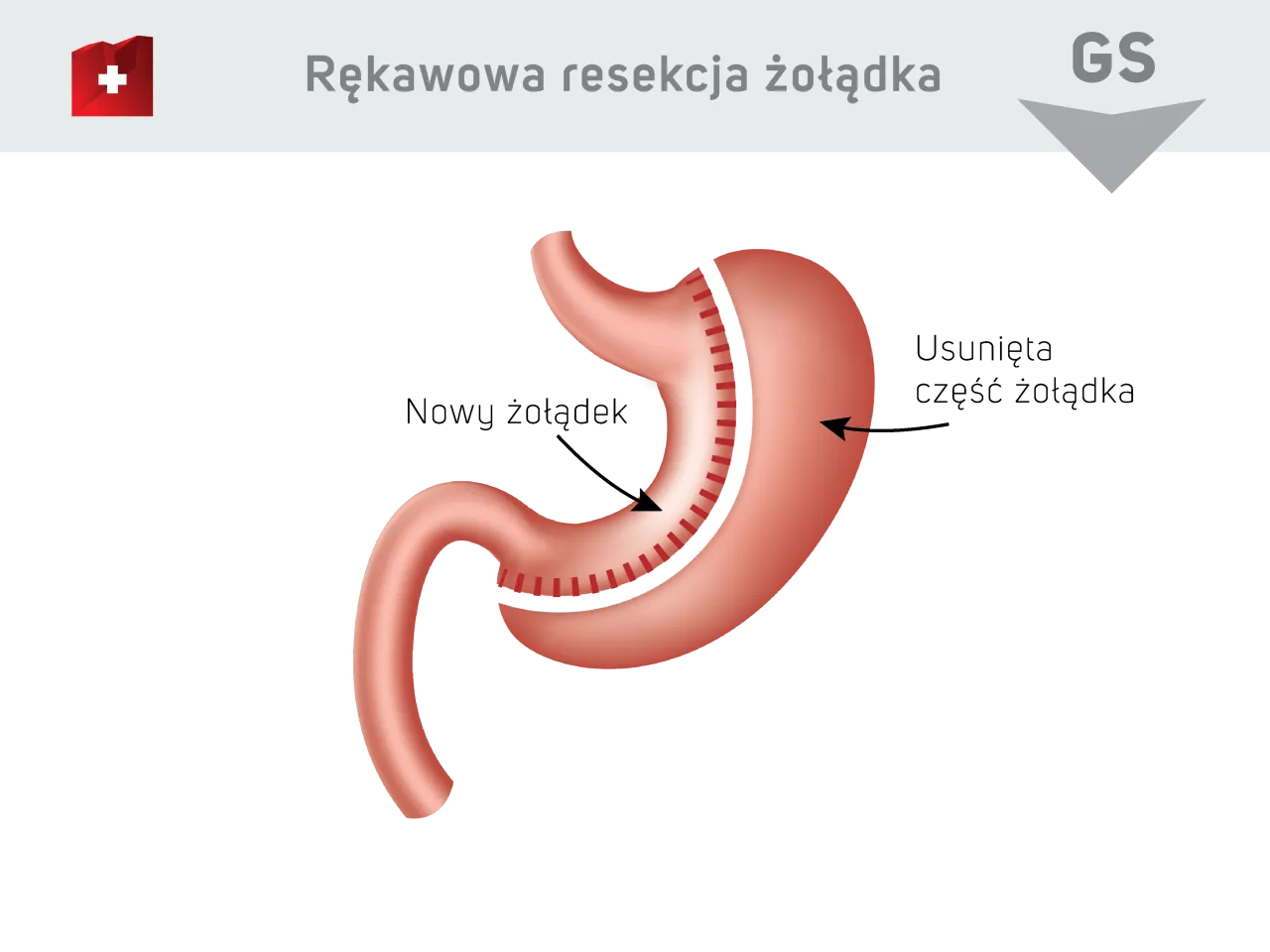Zdjęcie Operacja zmniejszenia żołądka nfz gdzie - sprawdź najlepsze ośrodki