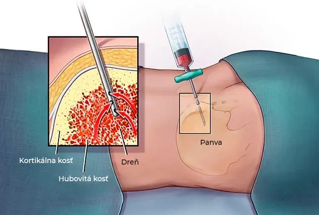 biopsja aspiracyjna szpiku vs trepanobiopsja schemat