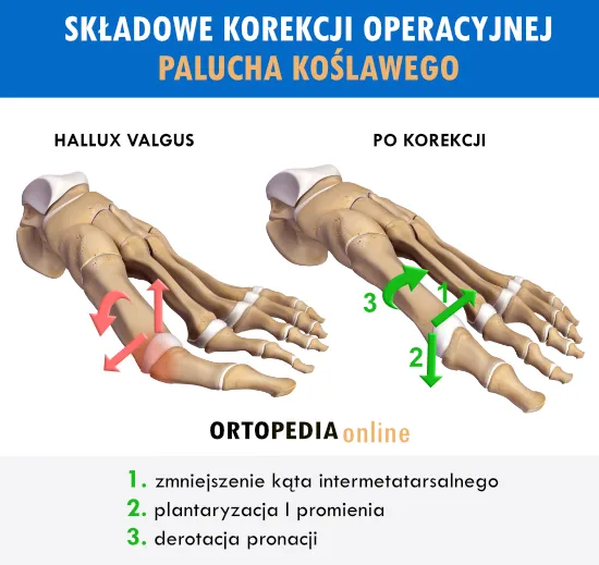 operacja haluksa metody