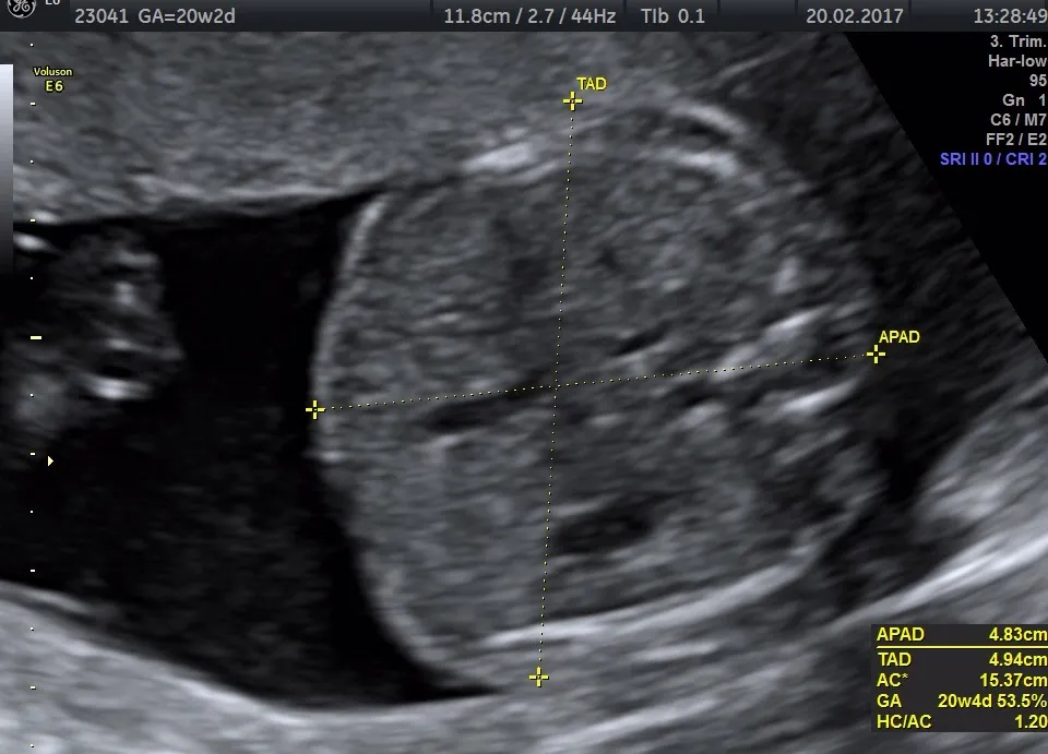 USG poł&oacute;wkowe ciąża