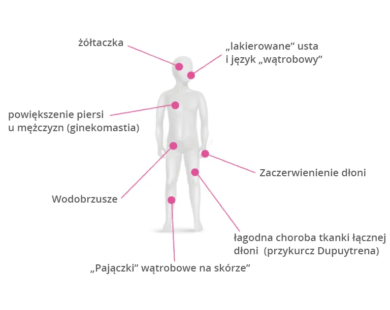 Zdjęcie Objawy marskości wątroby u alkoholika: jak je rozpoznać i uniknąć komplikacji