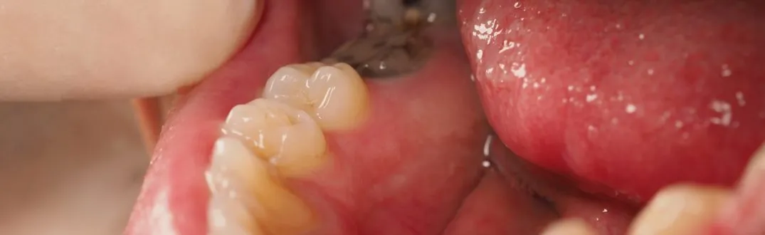 objawy zęba do leczenia kanałowego wizualne