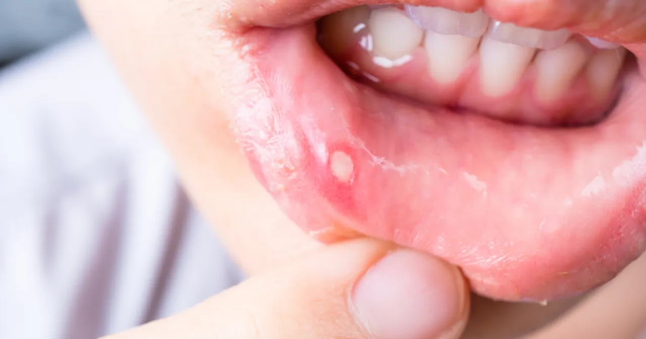 Różnice między aftą, pleśniawką a opryszczką w jamie ustnej