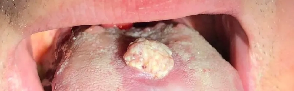 Objawy HPV w jamie ustnej - brodawczaki, zmiany na języku