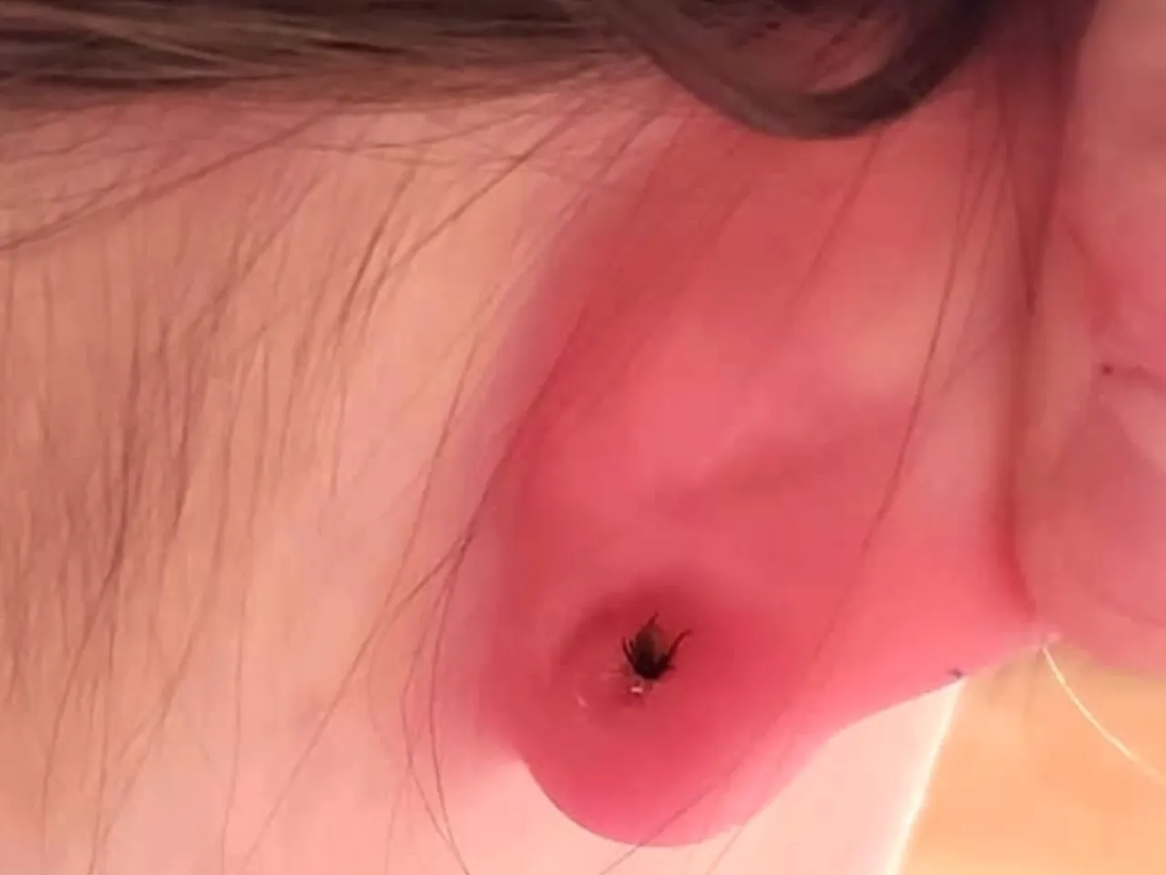 kleszcz w uchu objawy