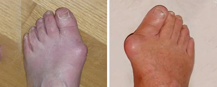 dna moczanowa a haluksy por&oacute;wnanie