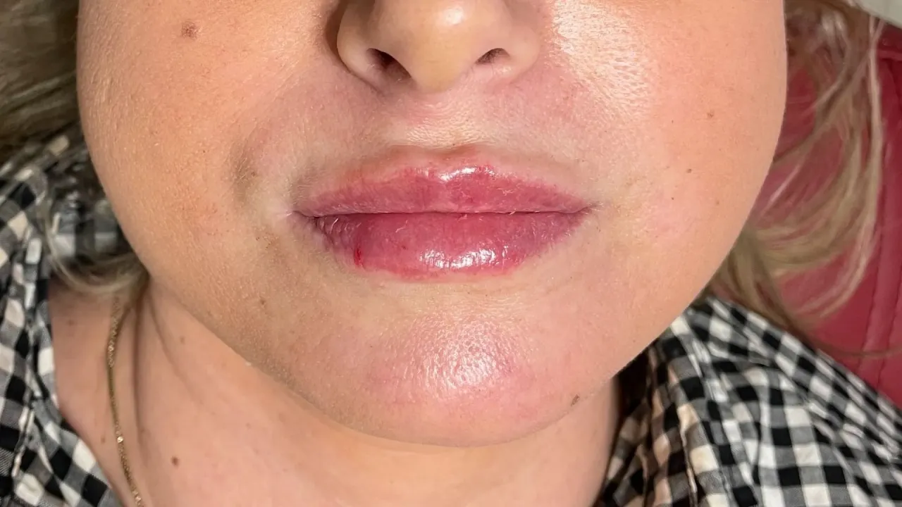 Opuchlizna po kwasie hialuronowym reakcja organizmu