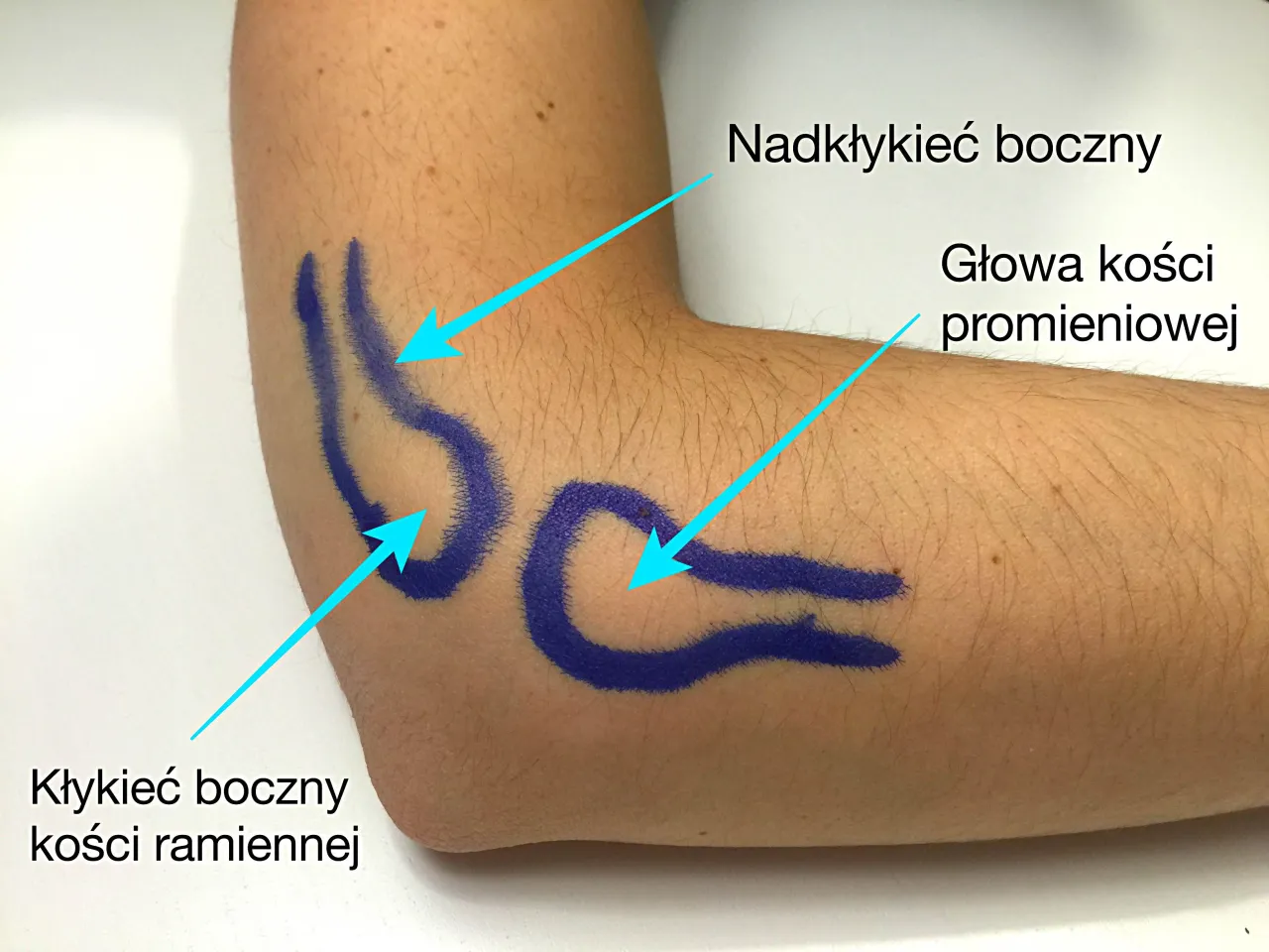 Łokieć tenisisty anatomia, przyczyny