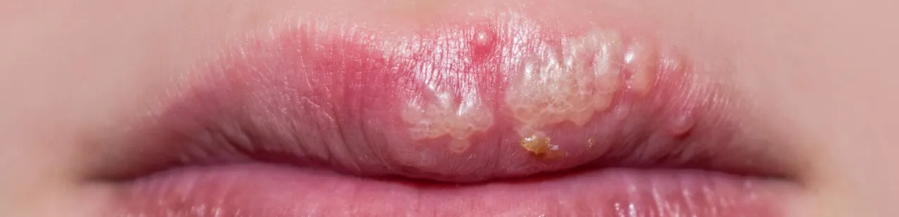 Opryszczka wargowa etapy rozwoju