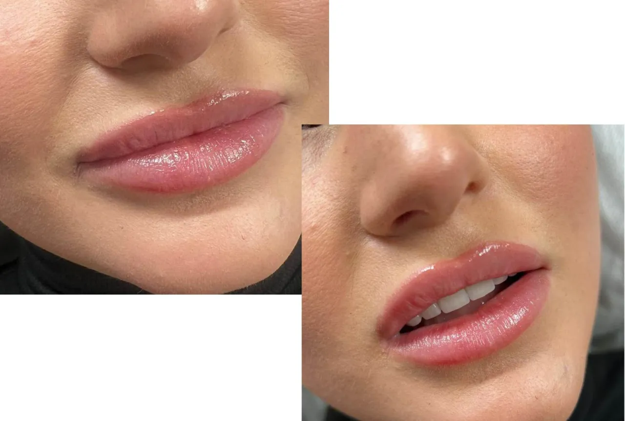 Lekarz medycyny estetycznej precyzyjnie wykonujący zabieg powiększania ust