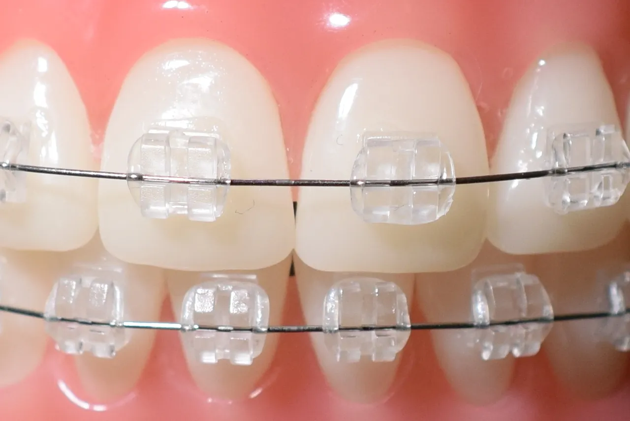 aparat ceramiczny na zębach