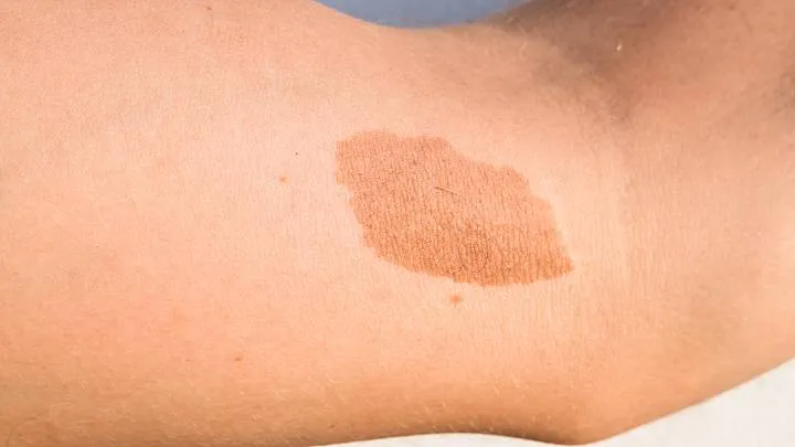 Zdjęcie Milchkaffee Fleck: Ursachen, Behandlung und wichtige Informationen