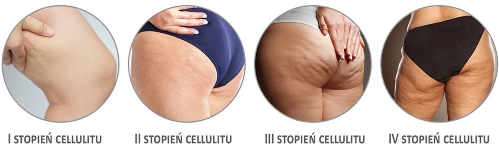 Rodzaje cellulitu i jego stopnie zaawansowania