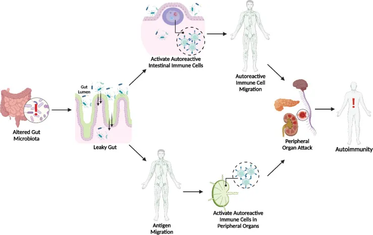 Zdjęcie Choroby autoimmunologiczne jelit: 5 głównych przyczyn i terapii