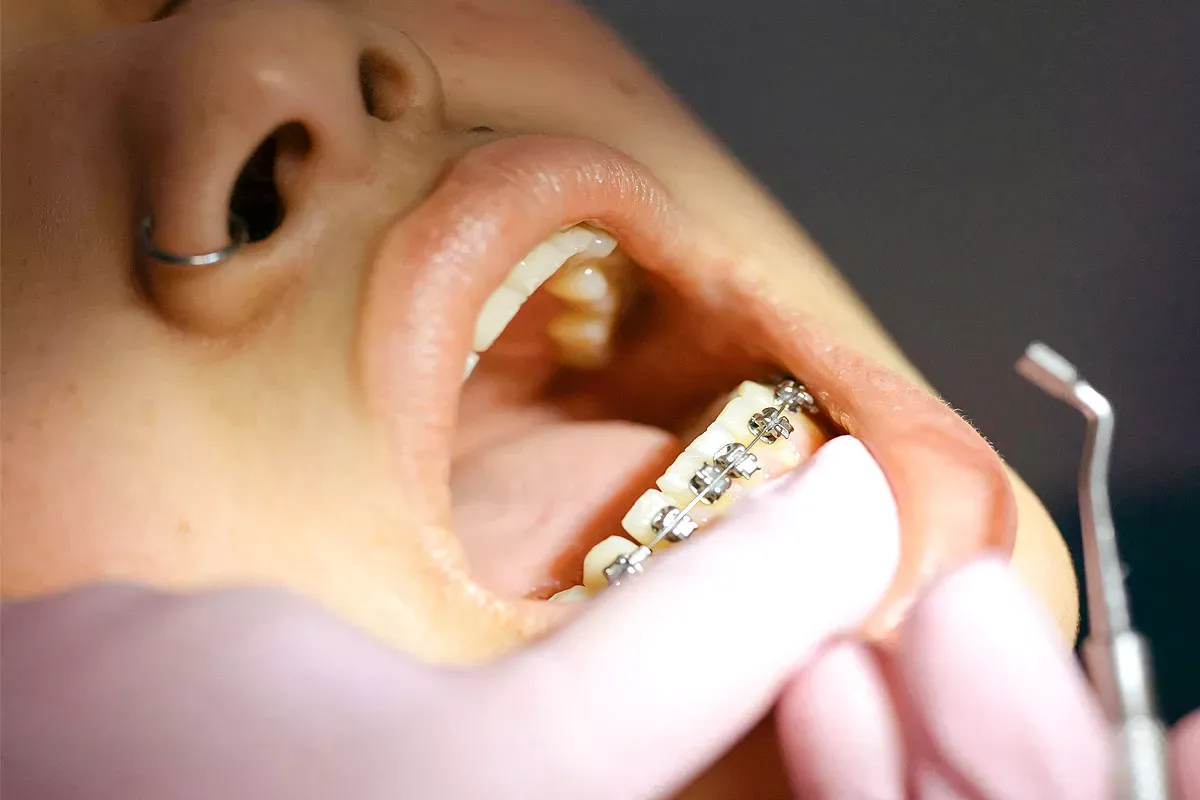 Zdjęcie Zakładanie aparatu ortodontycznego: Czy boli? Sprawdź, czego się spodziewać!