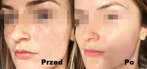 Zdjęcie Jaki krem po peelingu kawitacyjnym? 5 najlepszych produktów