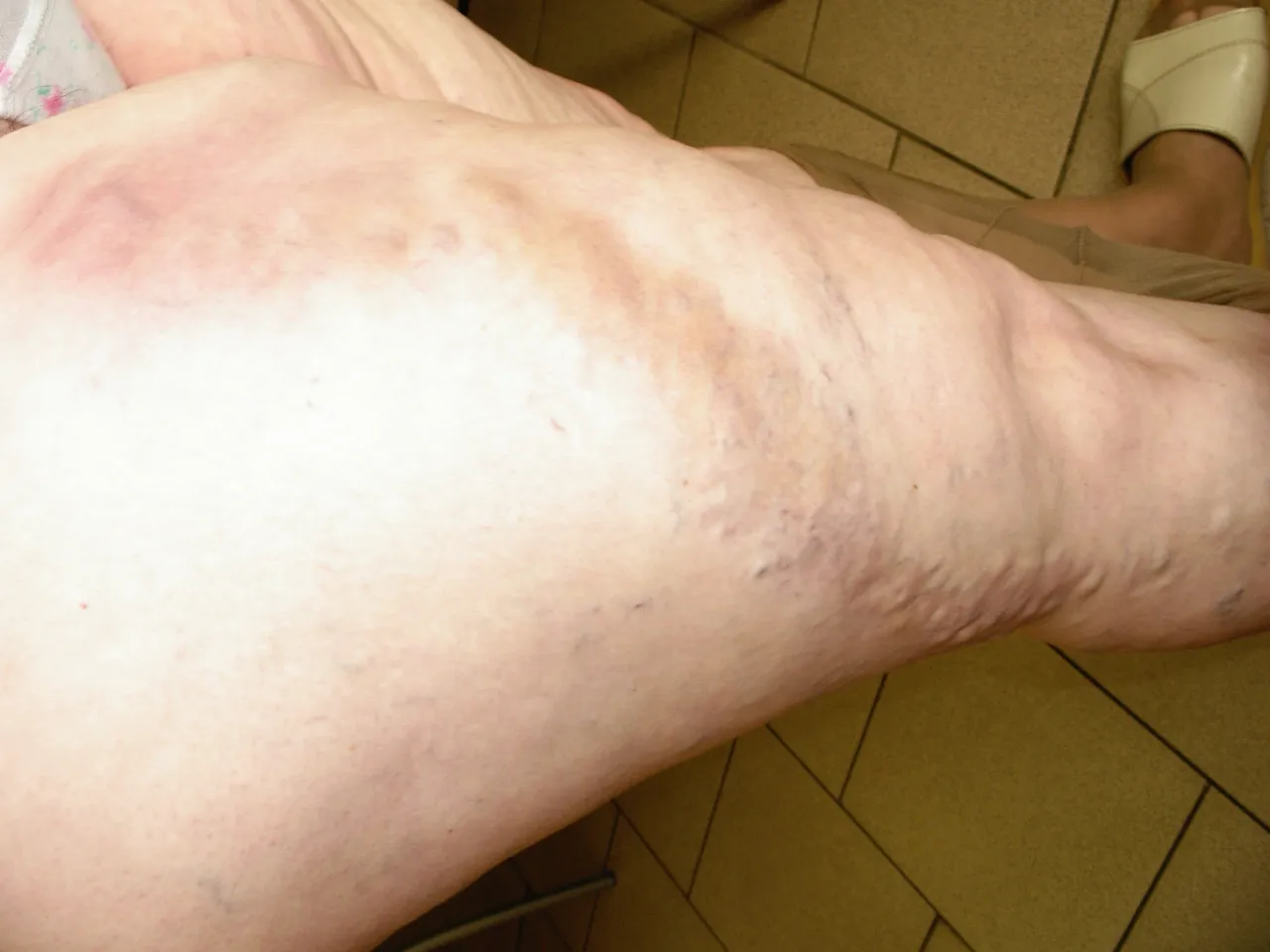 Zdjęcie Leki na zakrzepicę żył: Co działa, a co jest mitem?