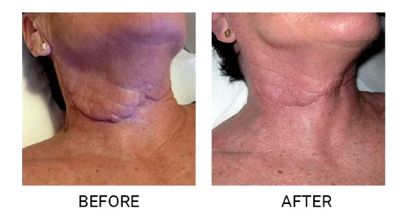 endermologia twarzy przed i po