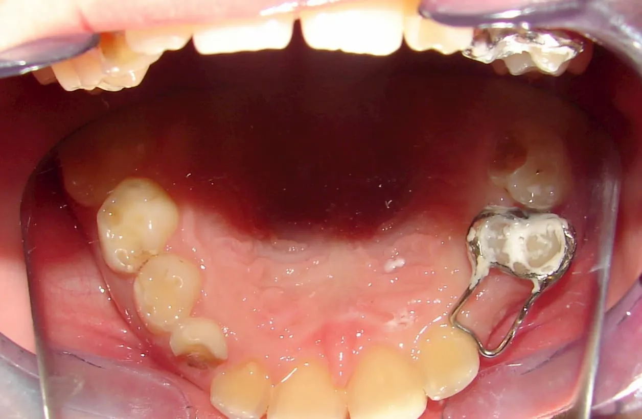 uszkodzone zęby domowy aparat ortodontyczny