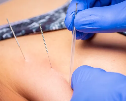 kinesiotaping suche igłowanie