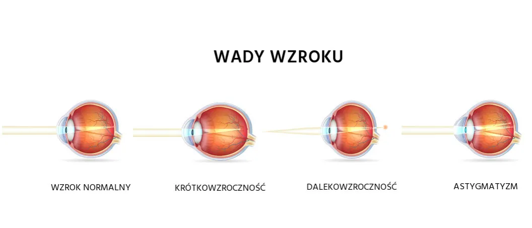 różne wady wzroku schemat