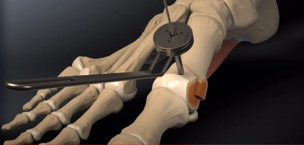 Mechanizm powstawania haluksów animacja