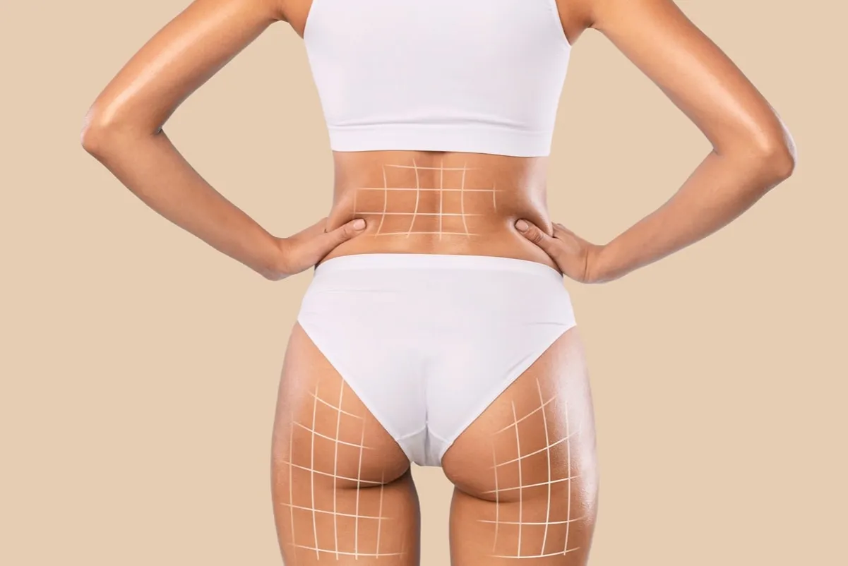 Zabiegi medycyny estetycznej modelujące sylwetkę