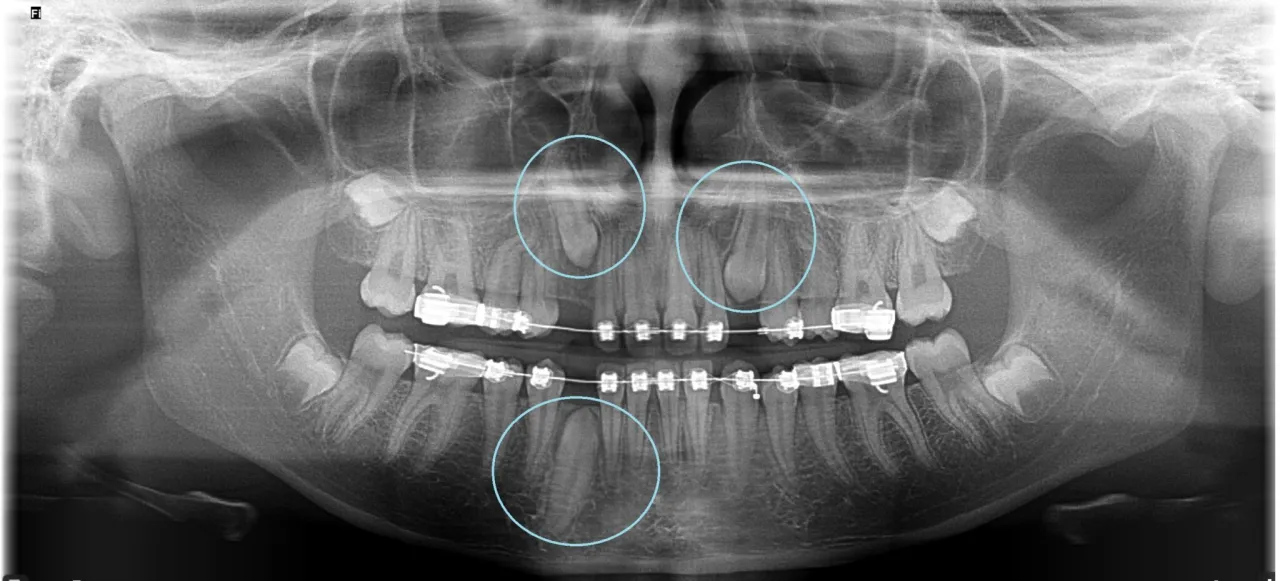 chirurgiczne odsłonięcie zęba schemat