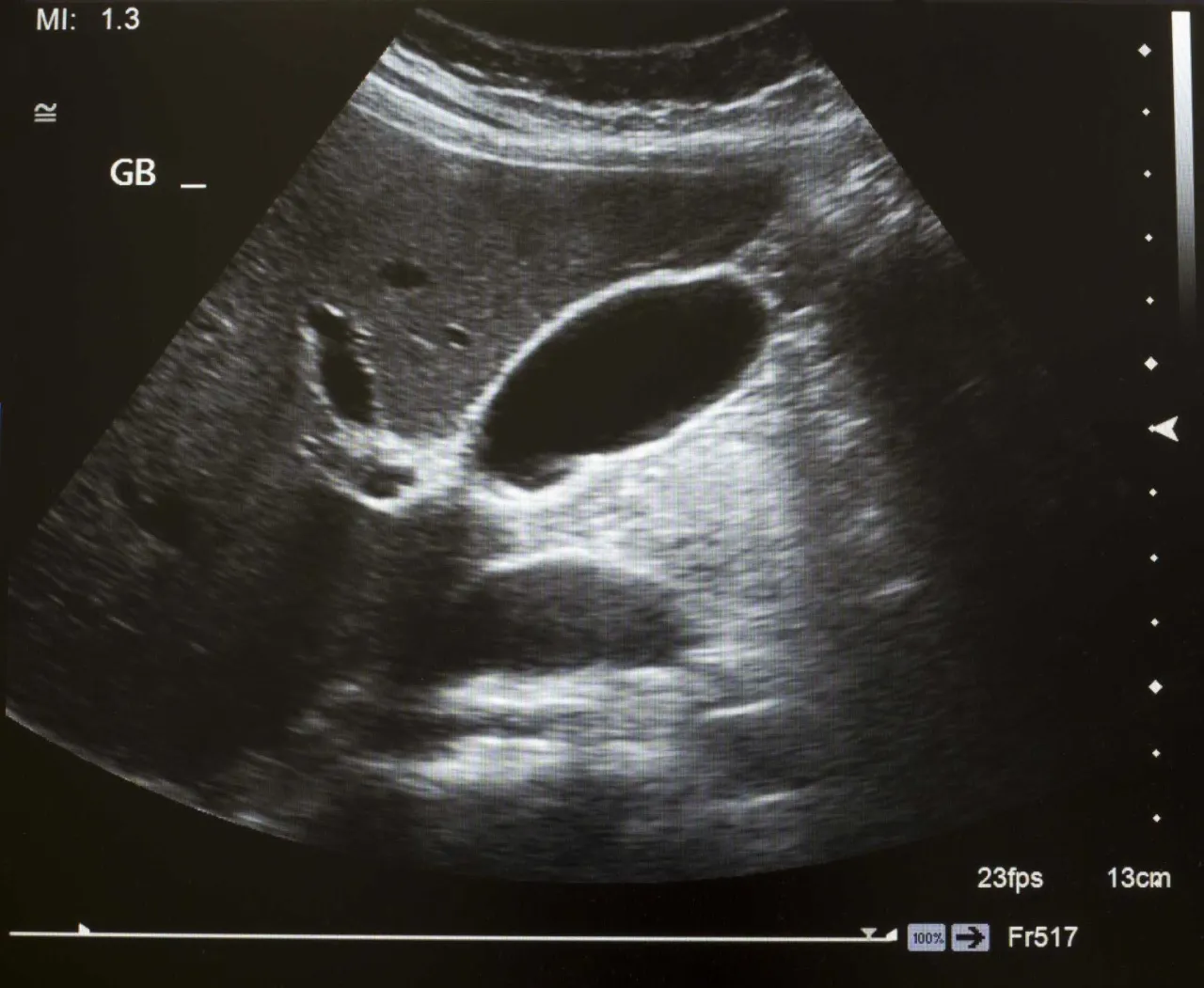 Arzt erklärt Ultraschallbild der Gallenblase