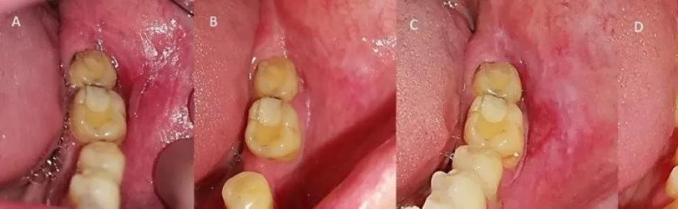 leczenie liszaja płaskiego jamy ustnej