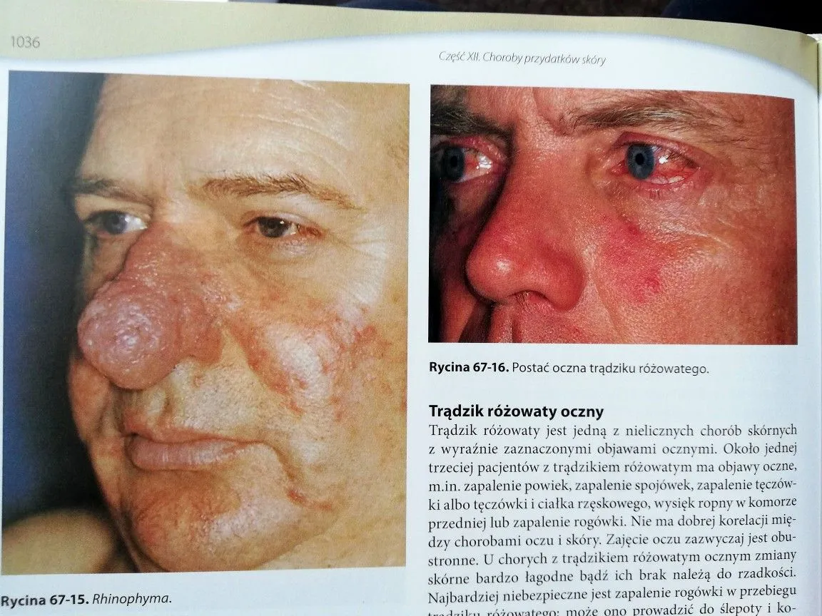 cera naczynkowa vs trądzik różowaty porównanie