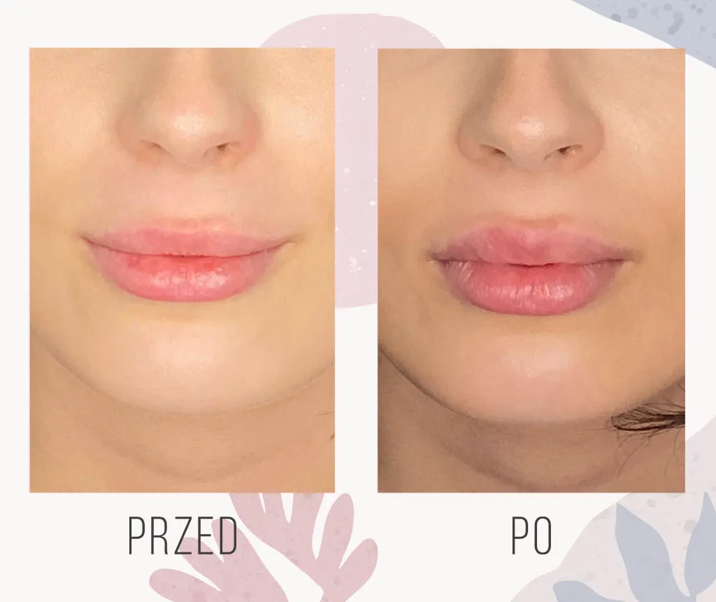Powiększanie ust przed i po