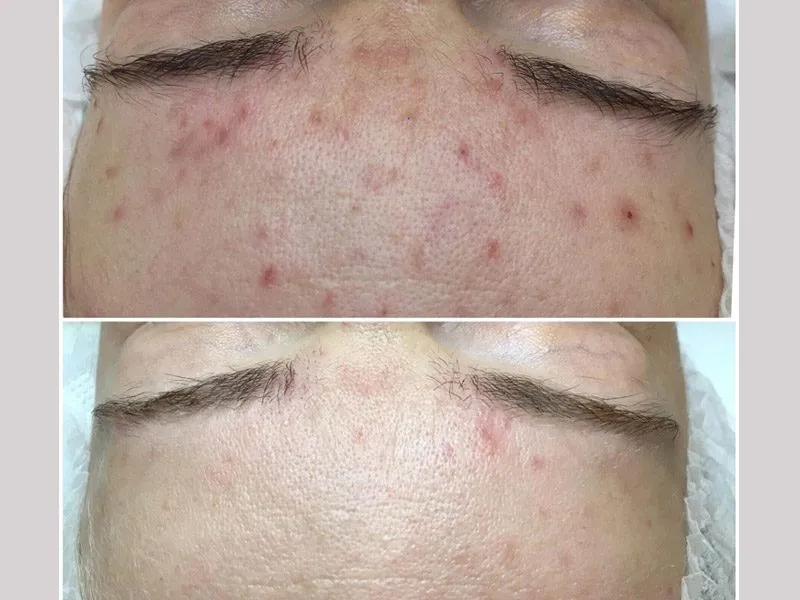 zabiegi kosmetyczne na pryszcze podskórne