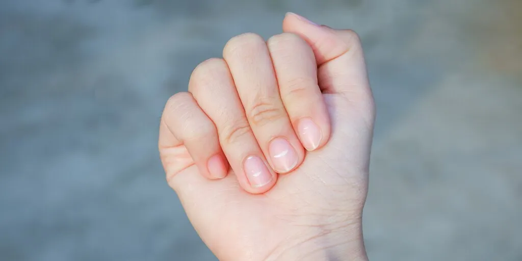 czerniak podpaznokciowy objaw Hutchinsona