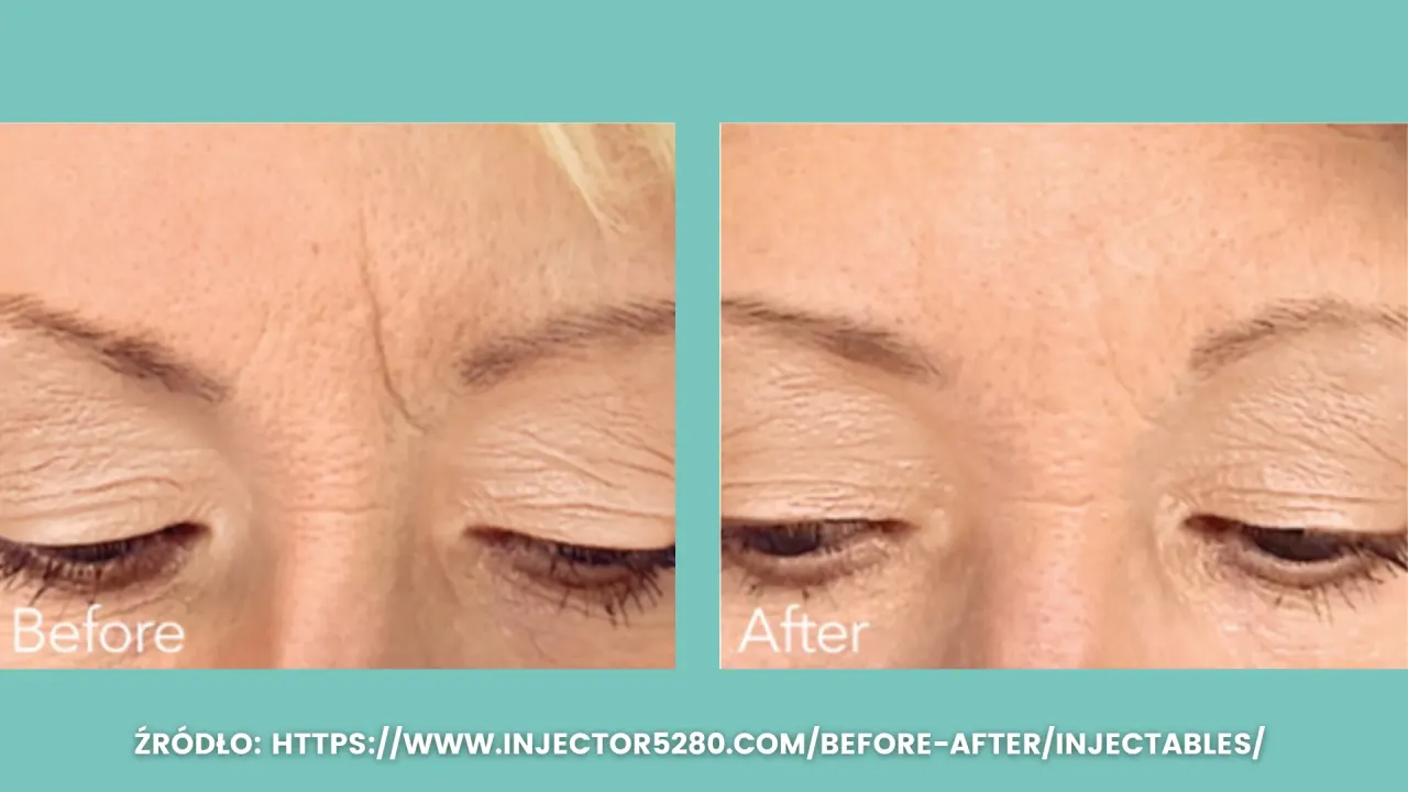 Kwas hialuronowy lwia zmarszczka przed po