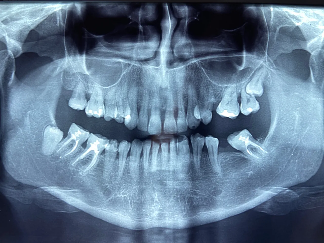 rentgen zatrzymana &oacute;semka żuchwa