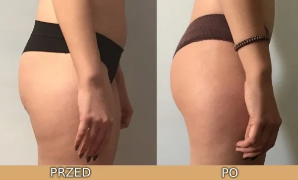 drenaż limfatyczny efekty przed po