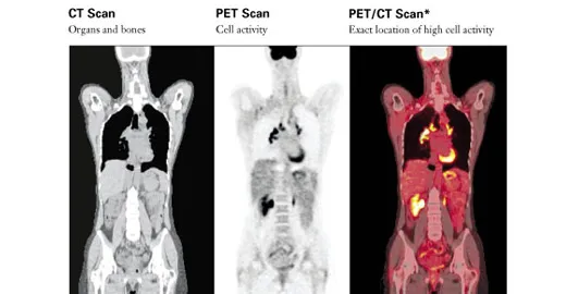 różne znaczniki PET-CT infografika
