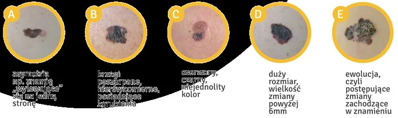 ABCDE czerniak przykłady