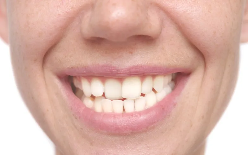 różne rodzaje wad zgryzu przykłady