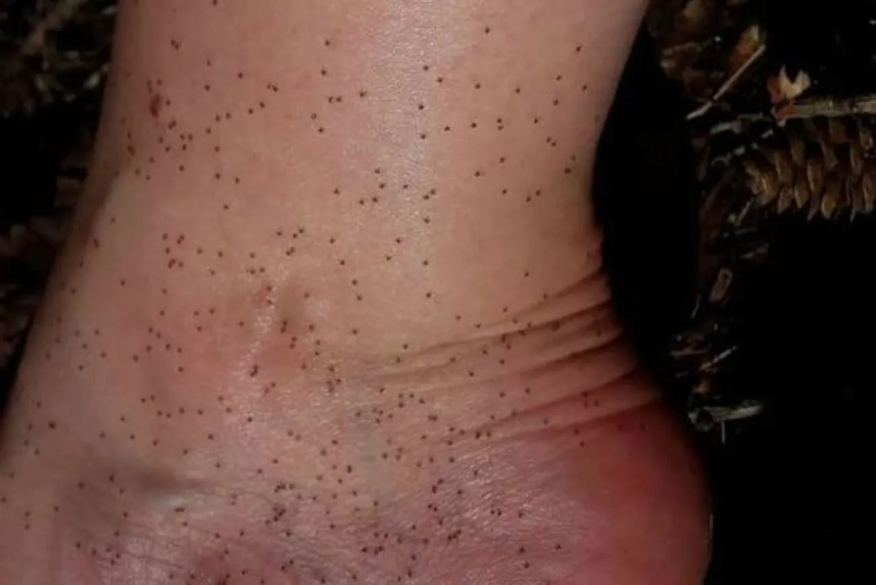 Kleszcz wbity w skórę różne stadia, kleszcz nimfa, kleszcz najedzony