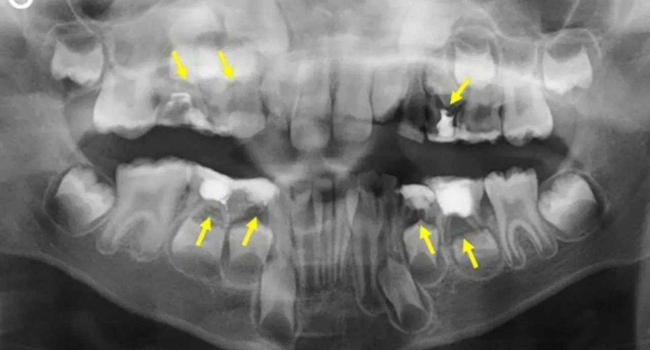 rentgen zęba ropień