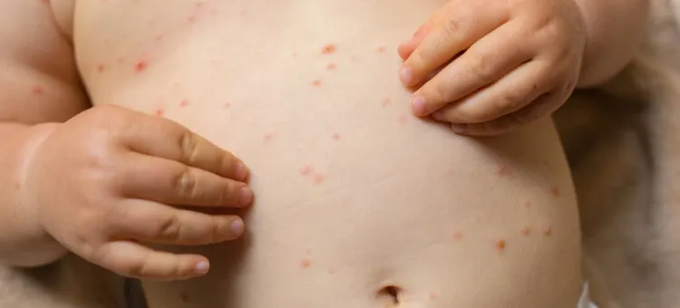 niemowlę objawy alarmowe ospa