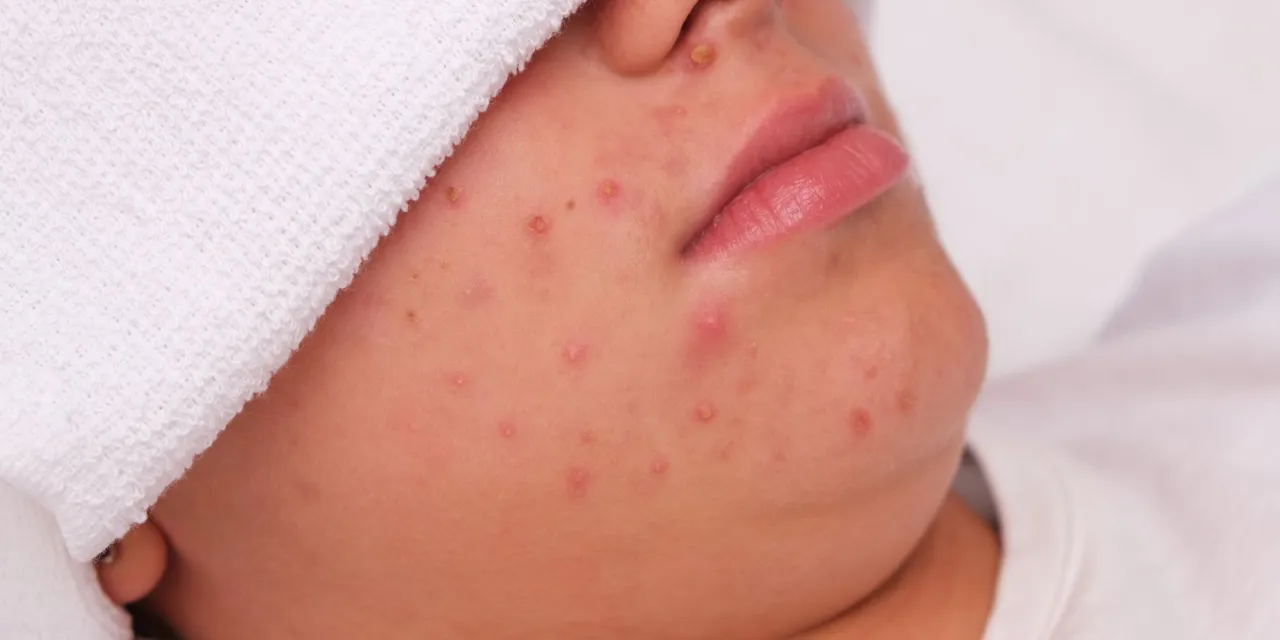 Kiedy iść do dermatologa z pryszczami podskórnymi
