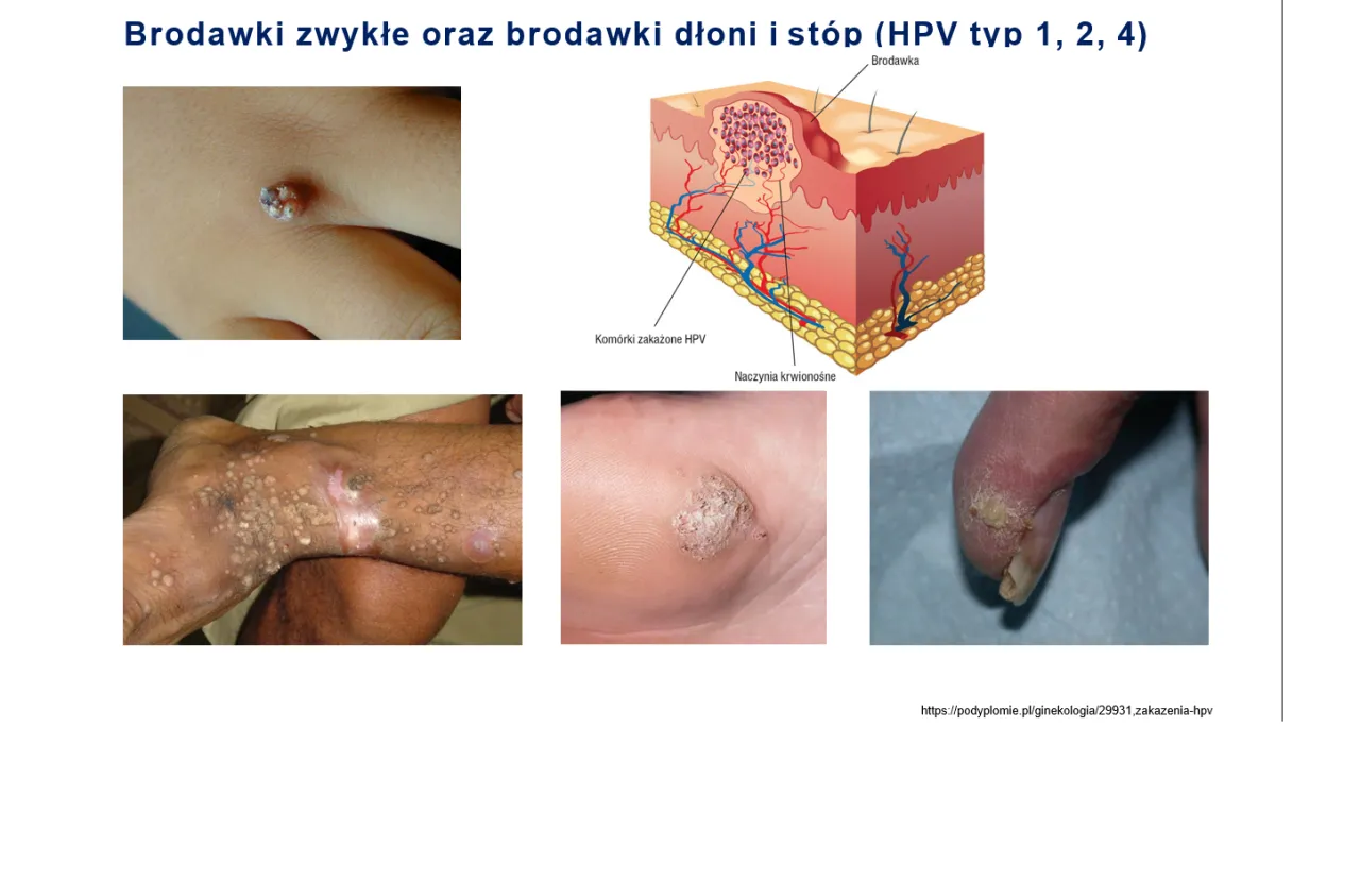 Niepokojące zmiany skórne okolice intymne HPV