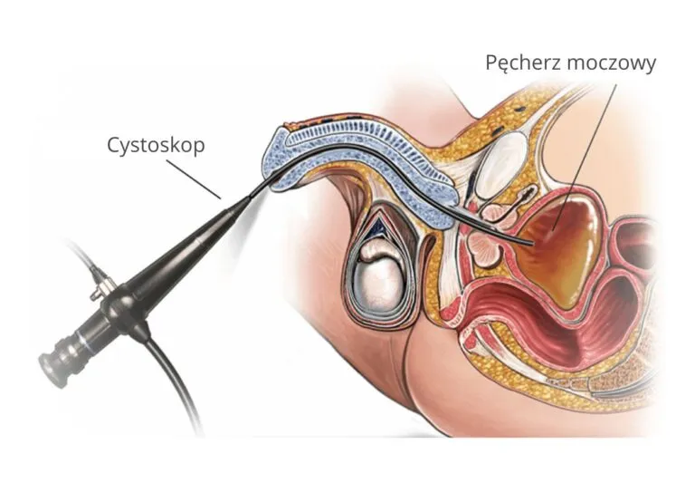 diagnostyka urologiczna badania usg cystoskopia