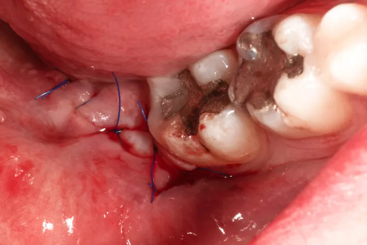 wyrzynająca się ósemka stan zapalny