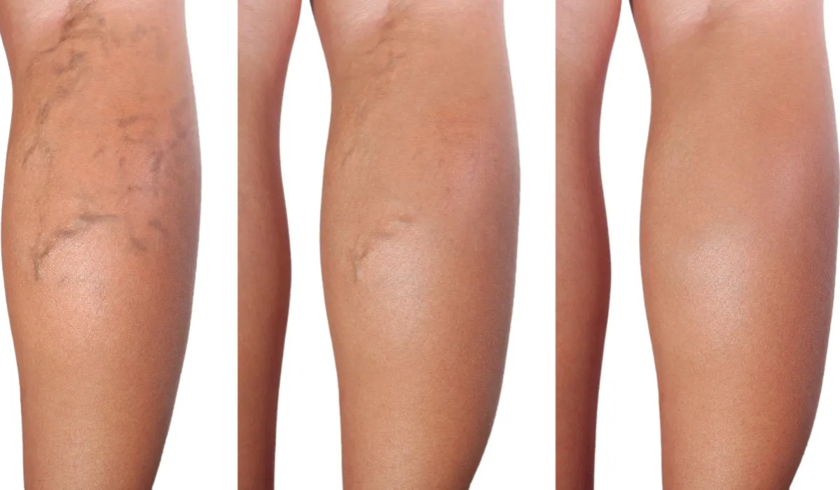 leczenie żylaków laserem i operacja bypass