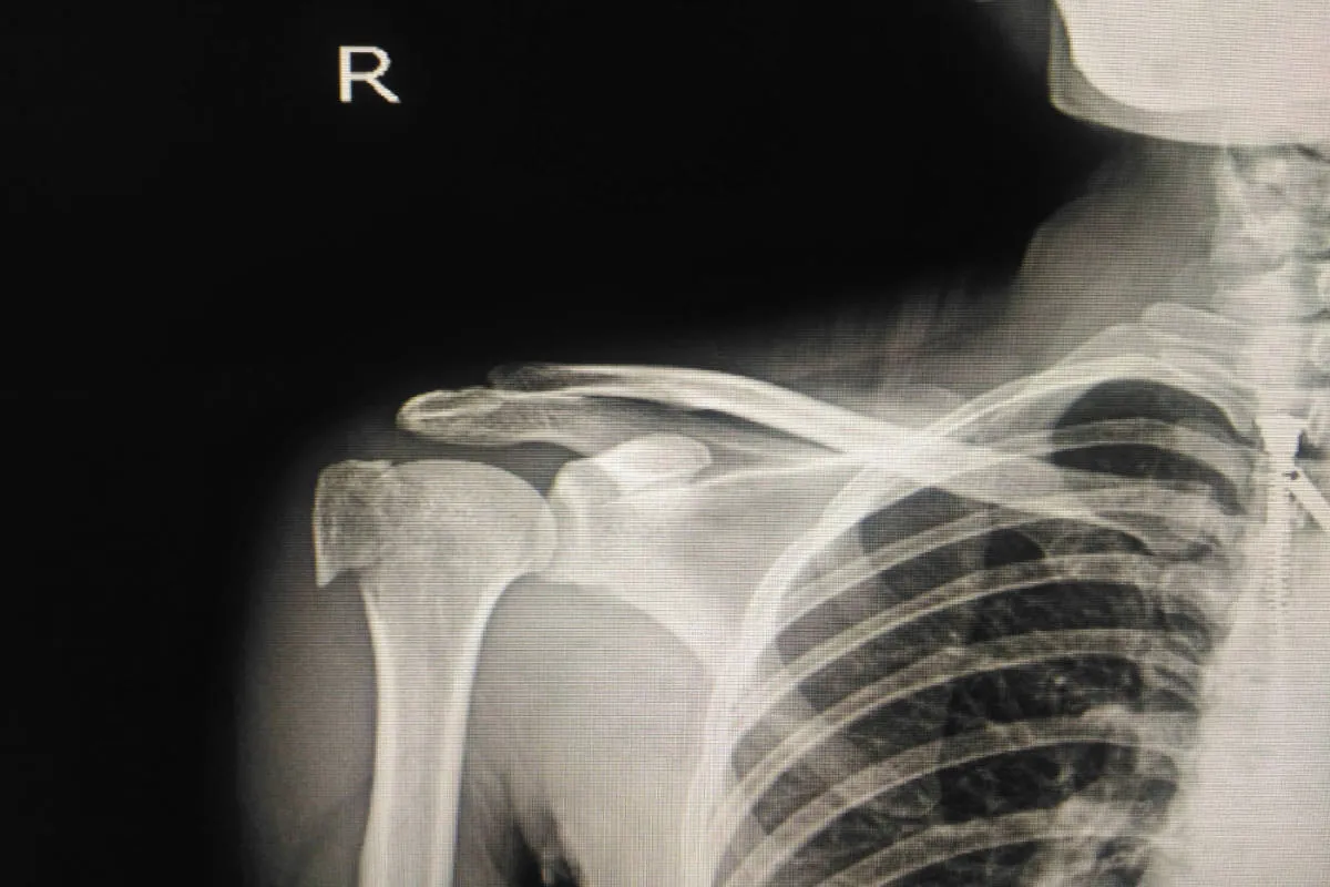 RTG prawego barku z widocznym złamaniem nasady bliższej kości ramiennej.