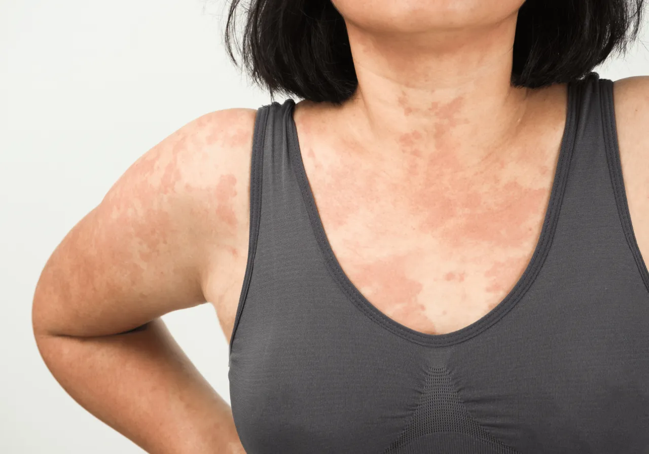 kobieta pije kawę i ma objawy alergii, wysypka, katar